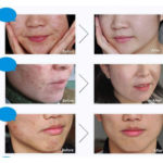 Acne face care | Bioaqua 7