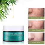 Tea Tree Anti Acne Skin Cream | SKIN EVER 7
